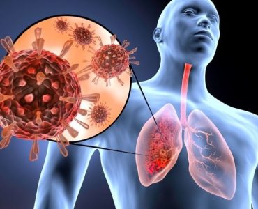 Eozinofilik Akciğer Hastalıkları Nedir?