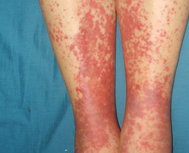 İmmünolojik Hastalıklar (Bağışıklık Sistem Hastalıkları)