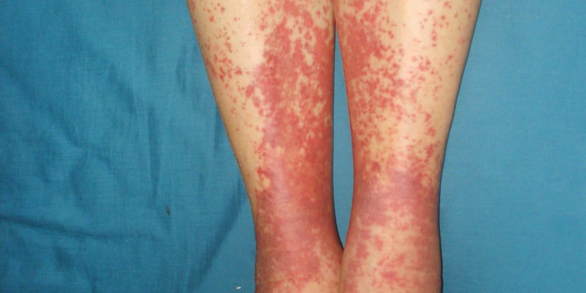 İmmünolojik Hastalıklar (Bağışıklık Sistem Hastalıkları)