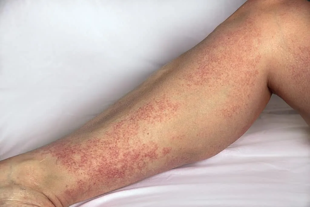 Vaskülit Nedir? Belirtileri Nedir?